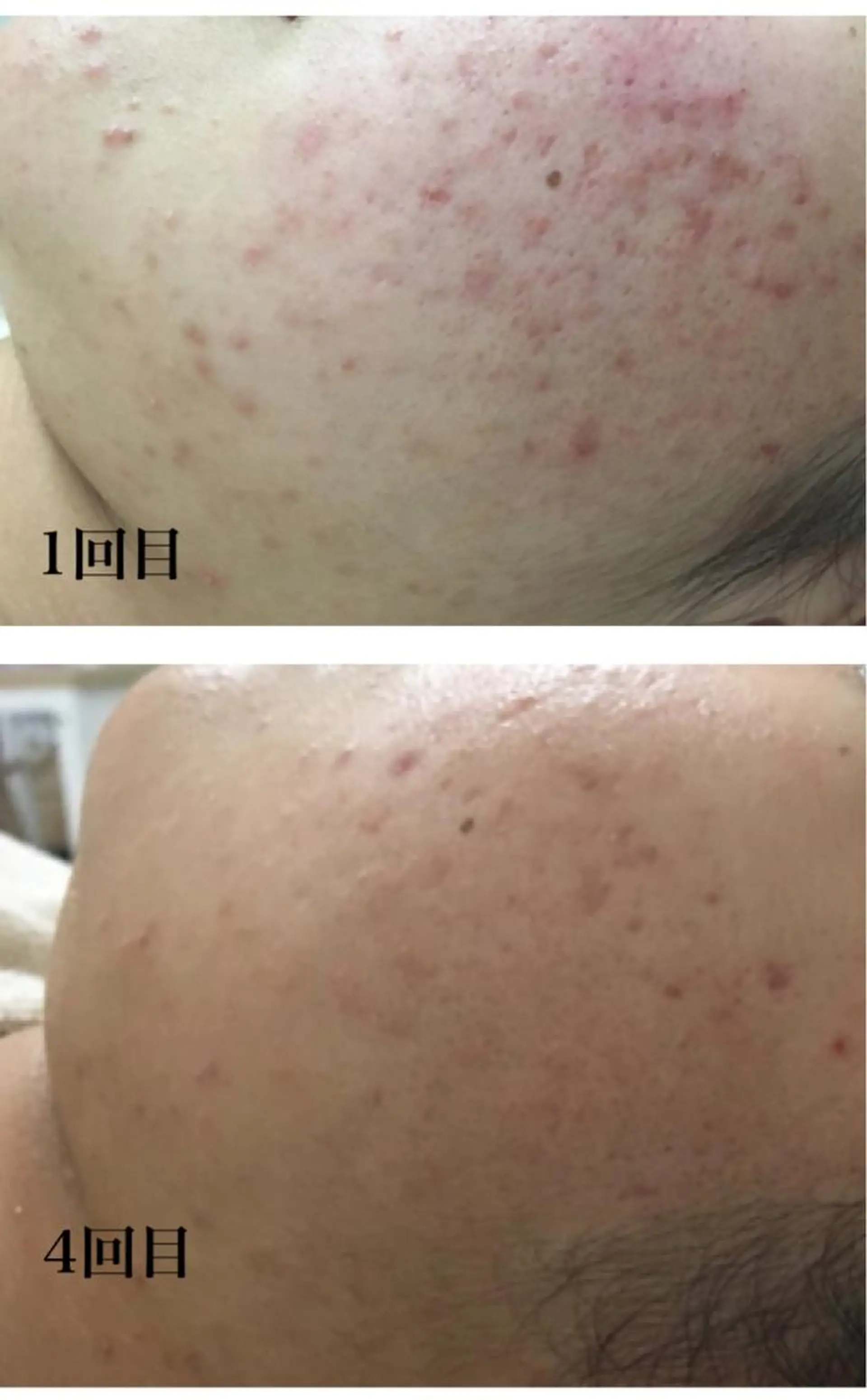 Meupニキビ専門店 背中/ハーブ/ララのその他イメージ