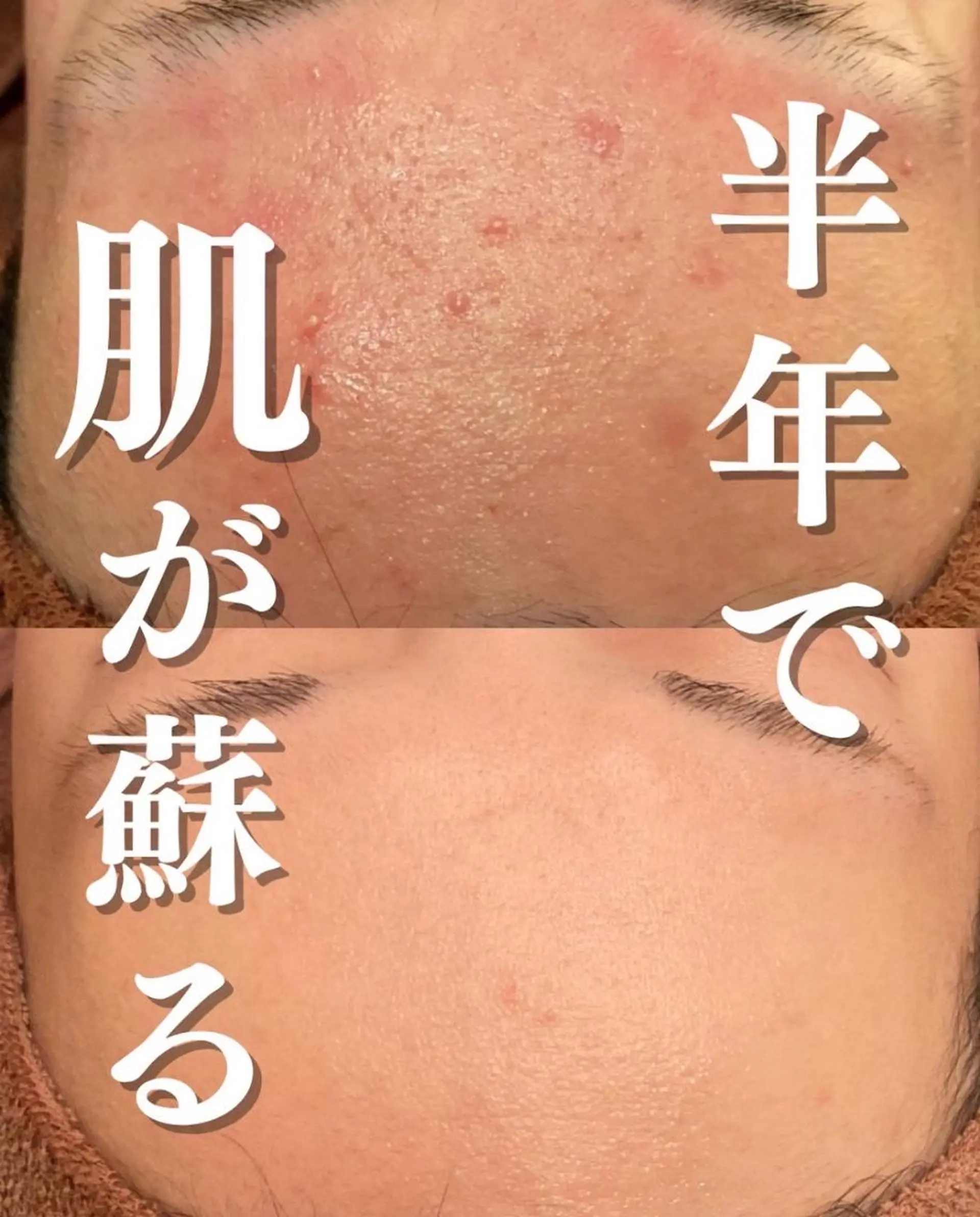 エステ リラク 皮膚科より効果あり ⁉️最短ニキビ改善のエステ・リラクイメージ