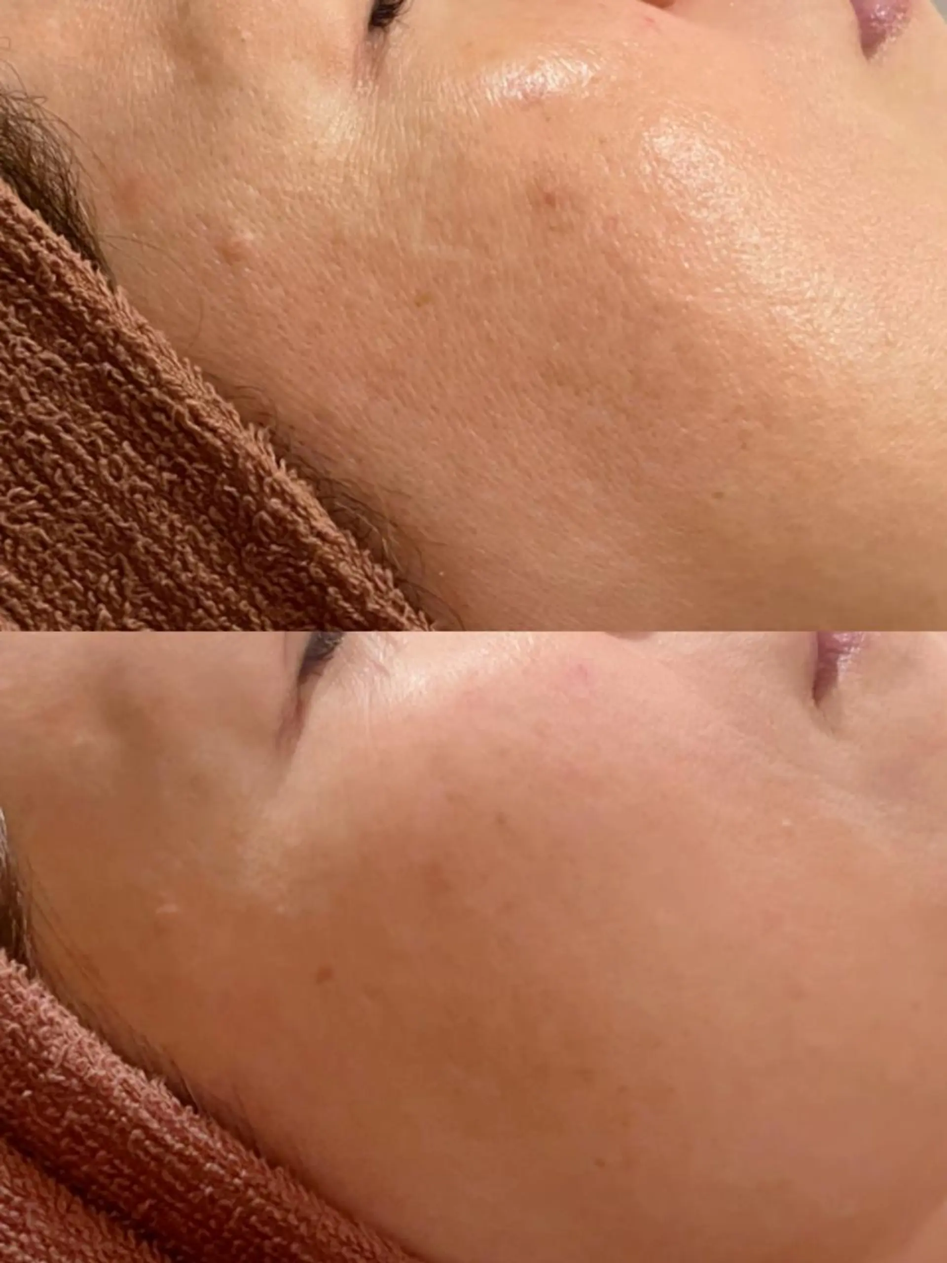 エステ リラク ニキビ跡改善専門🔥 医療にはできない改善のエステ・リラクイメージ