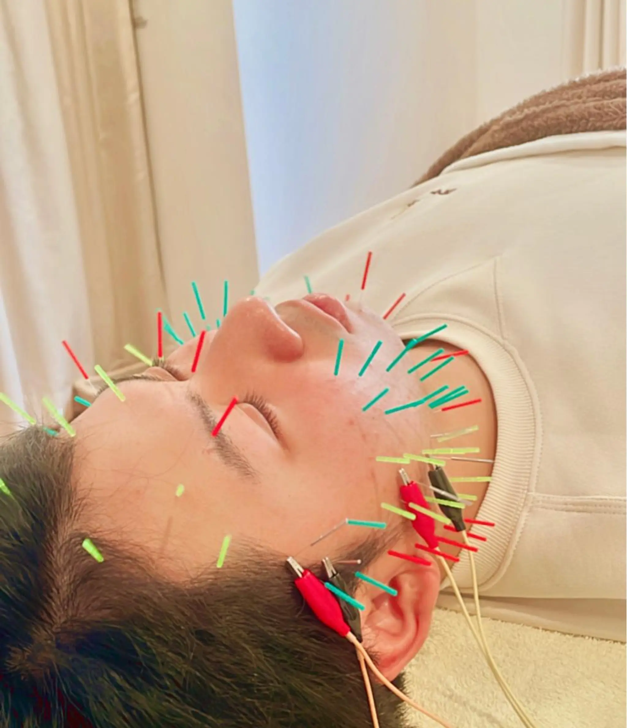 メンズ 美容鍼灸サロン　TIARA所属・鍼灸サロン TIARA　美容鍼のエステ・リラクイメージ