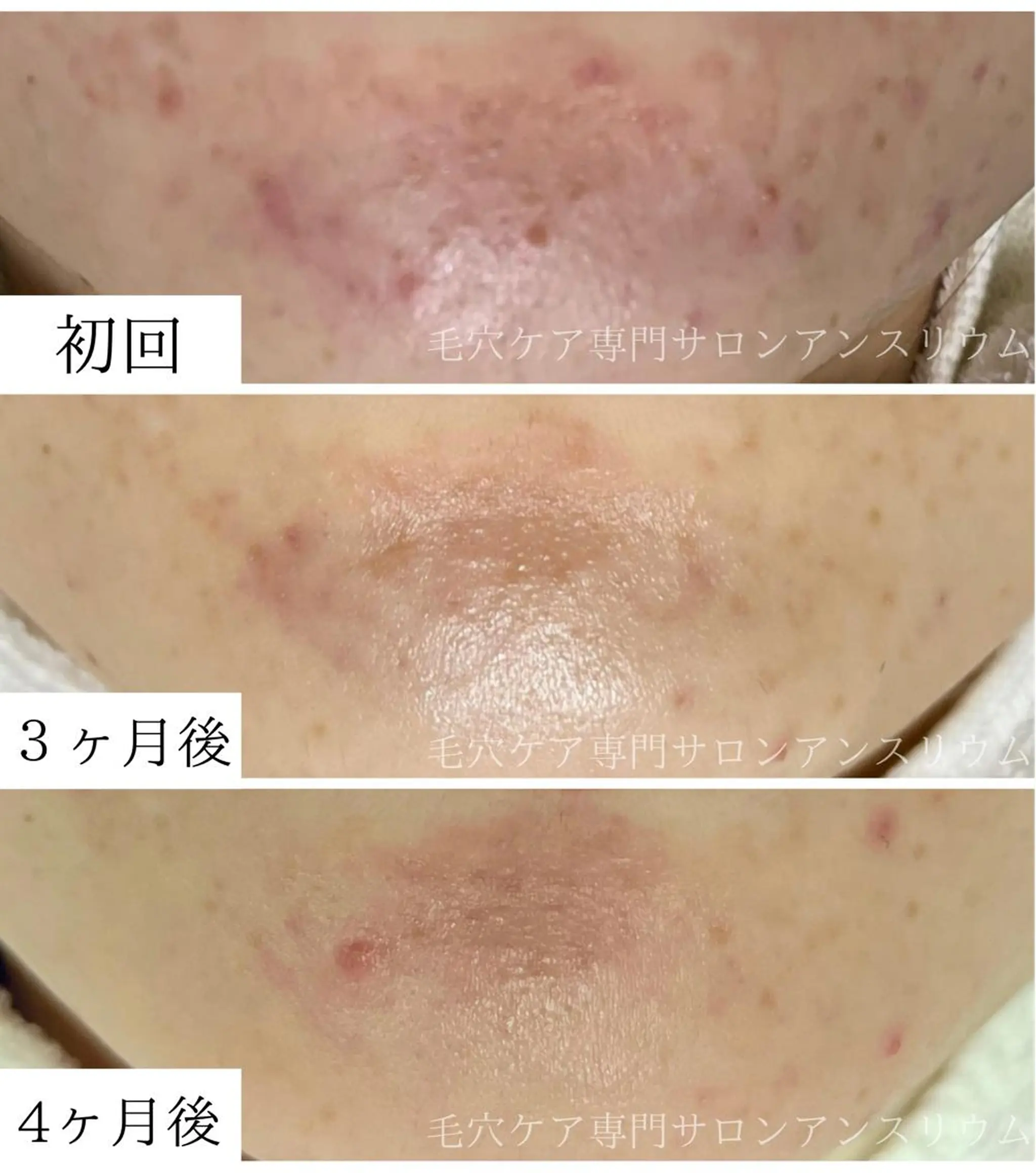 毛穴ケア専門サロンアンスリウム所属・茨城土浦 つくば毛穴 ケア専門サロンのエステ・リラクイメージ