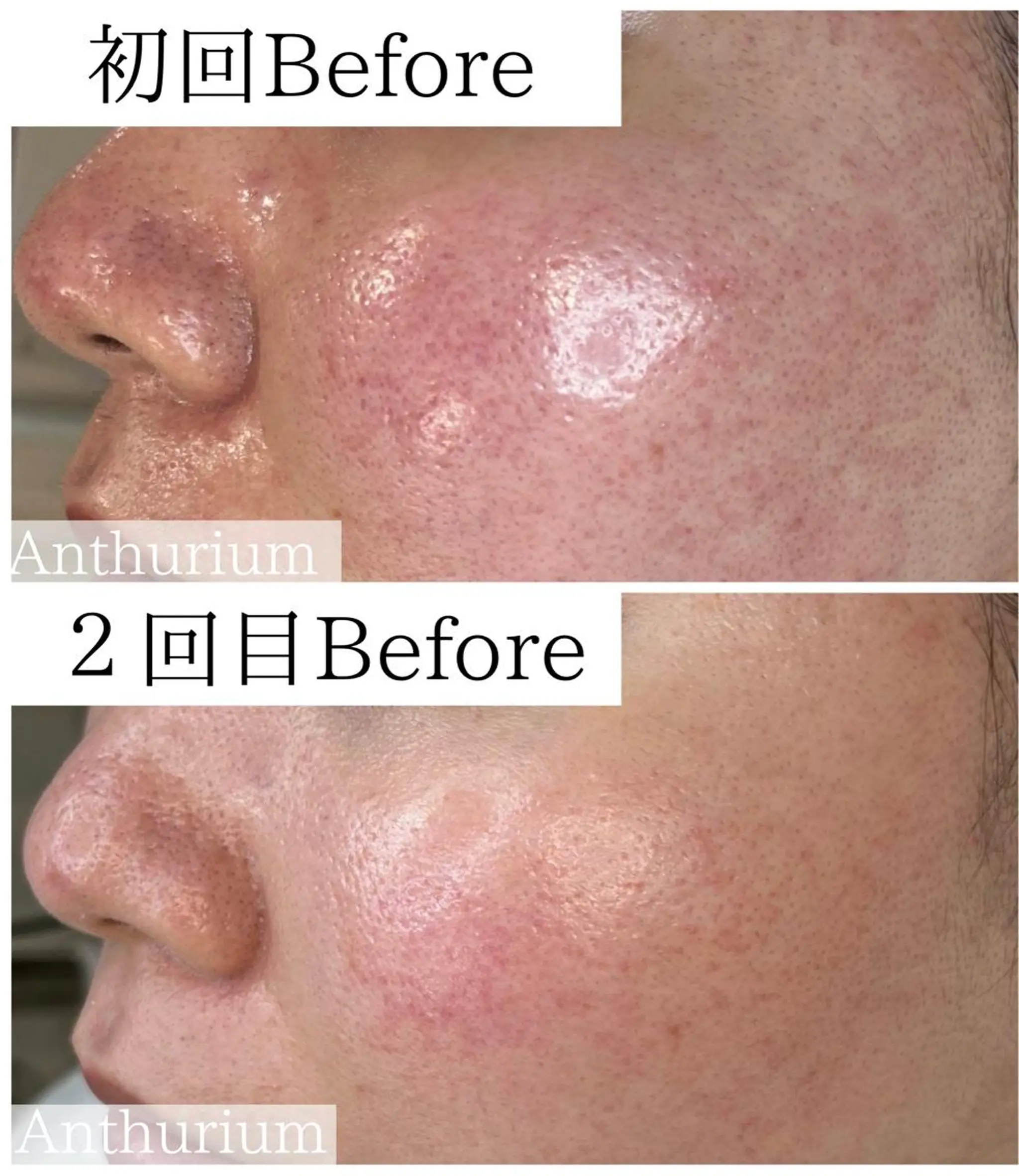 毛穴ケア専門サロンアンスリウム所属・茨城土浦 つくば毛穴 ケア専門サロンのエステ・リラクイメージ