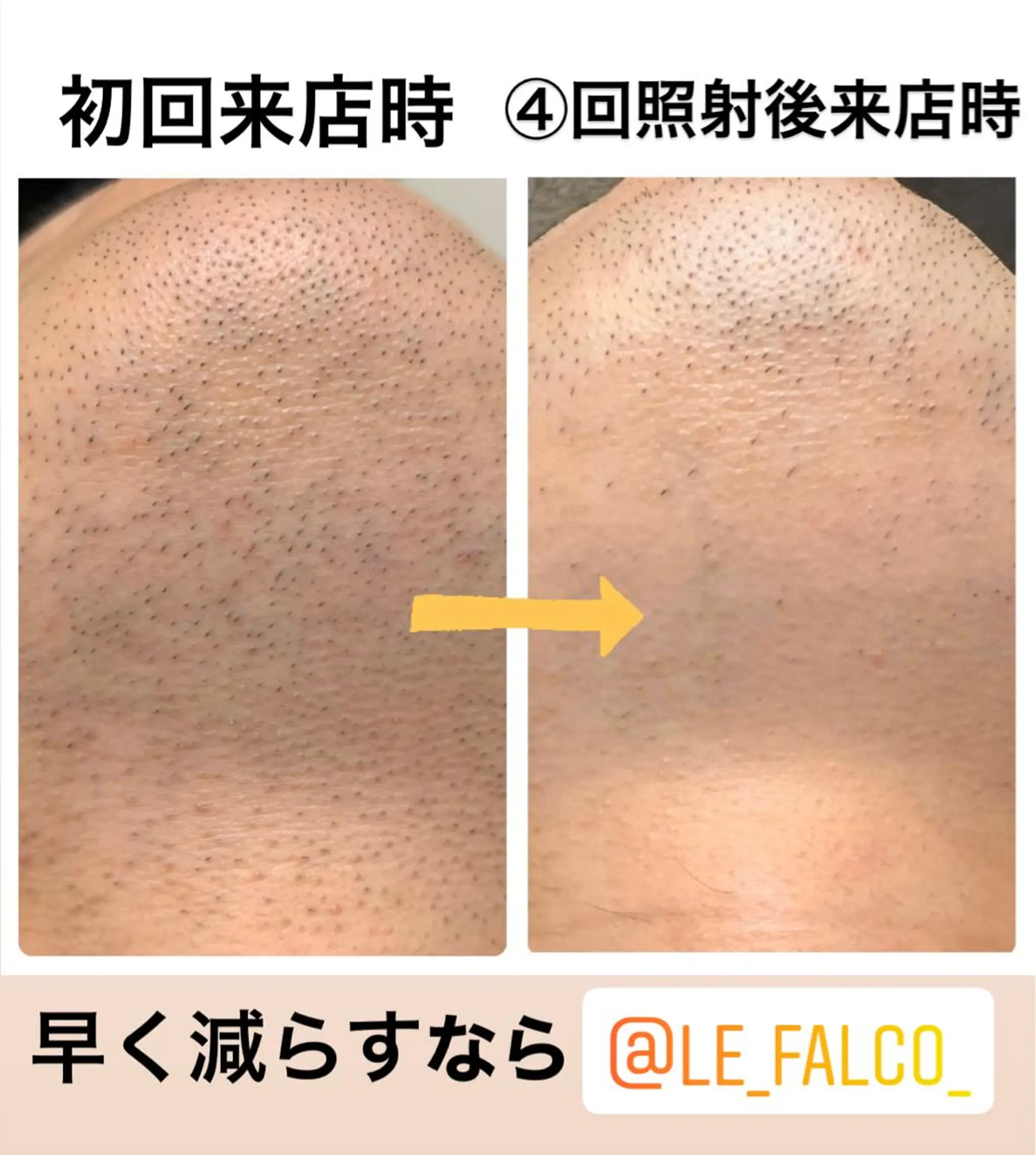 メンズ メンズハイライト メンズ脱毛サロン Le falcoのエステ・リラクイメージ