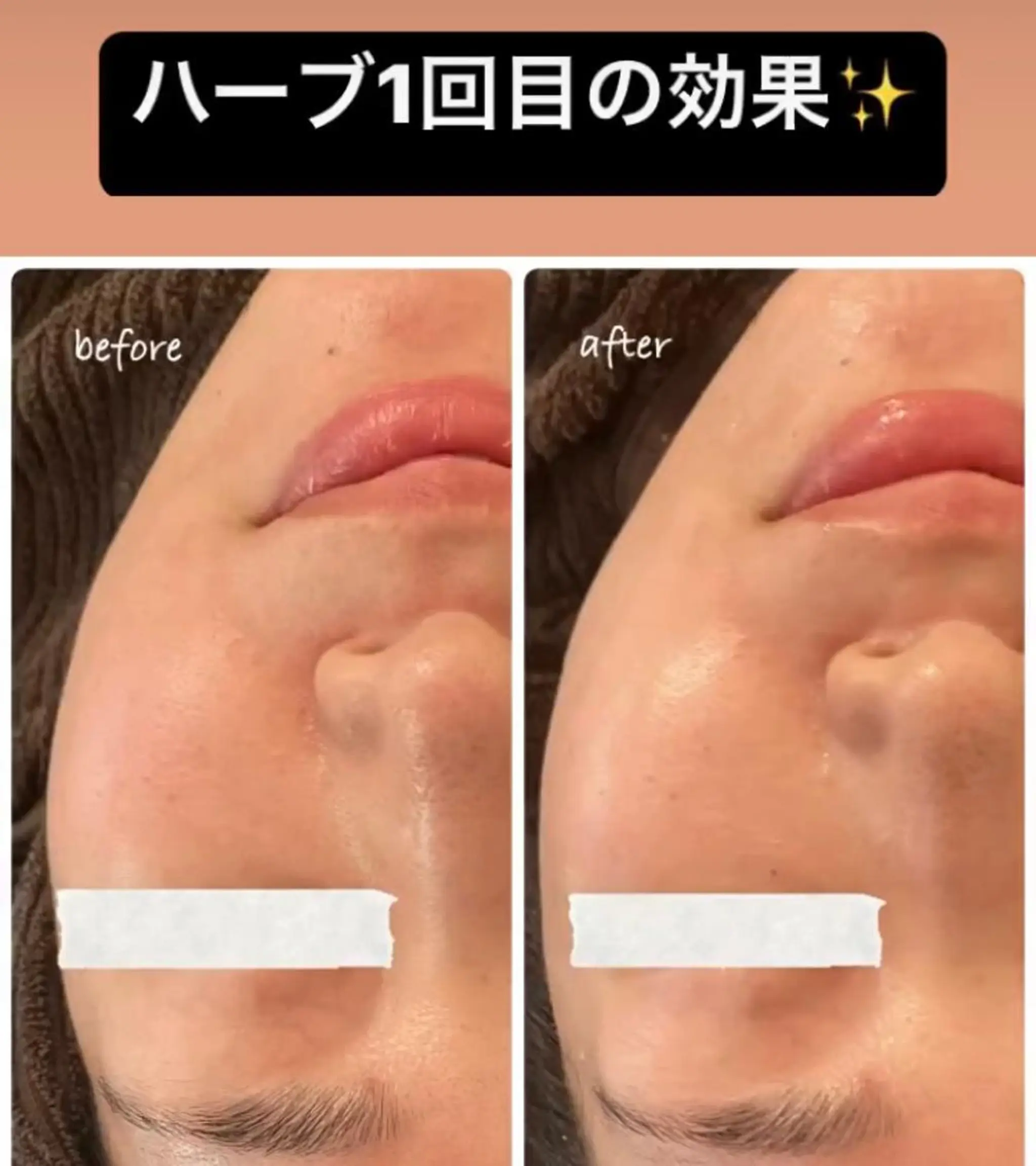 エステ luana beauty所属・kana ハーブピーリング🌿のエステ・リラクイメージ