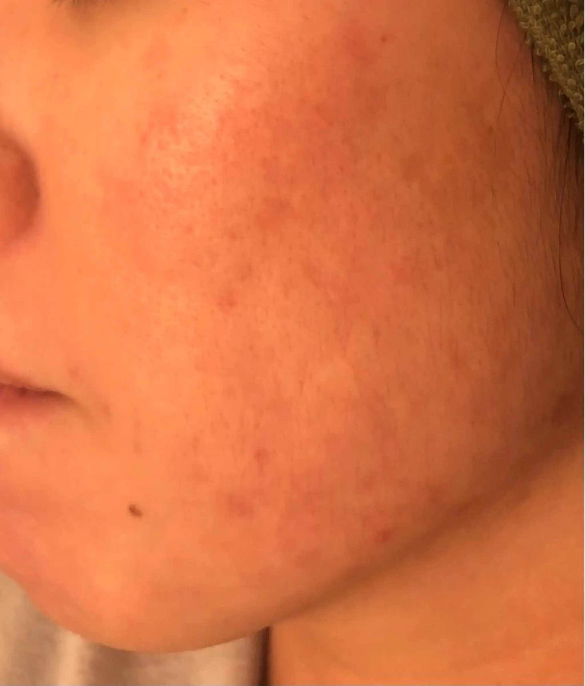 ニキビ専門サロン ド　ミモザのエステ・リラクイメージ