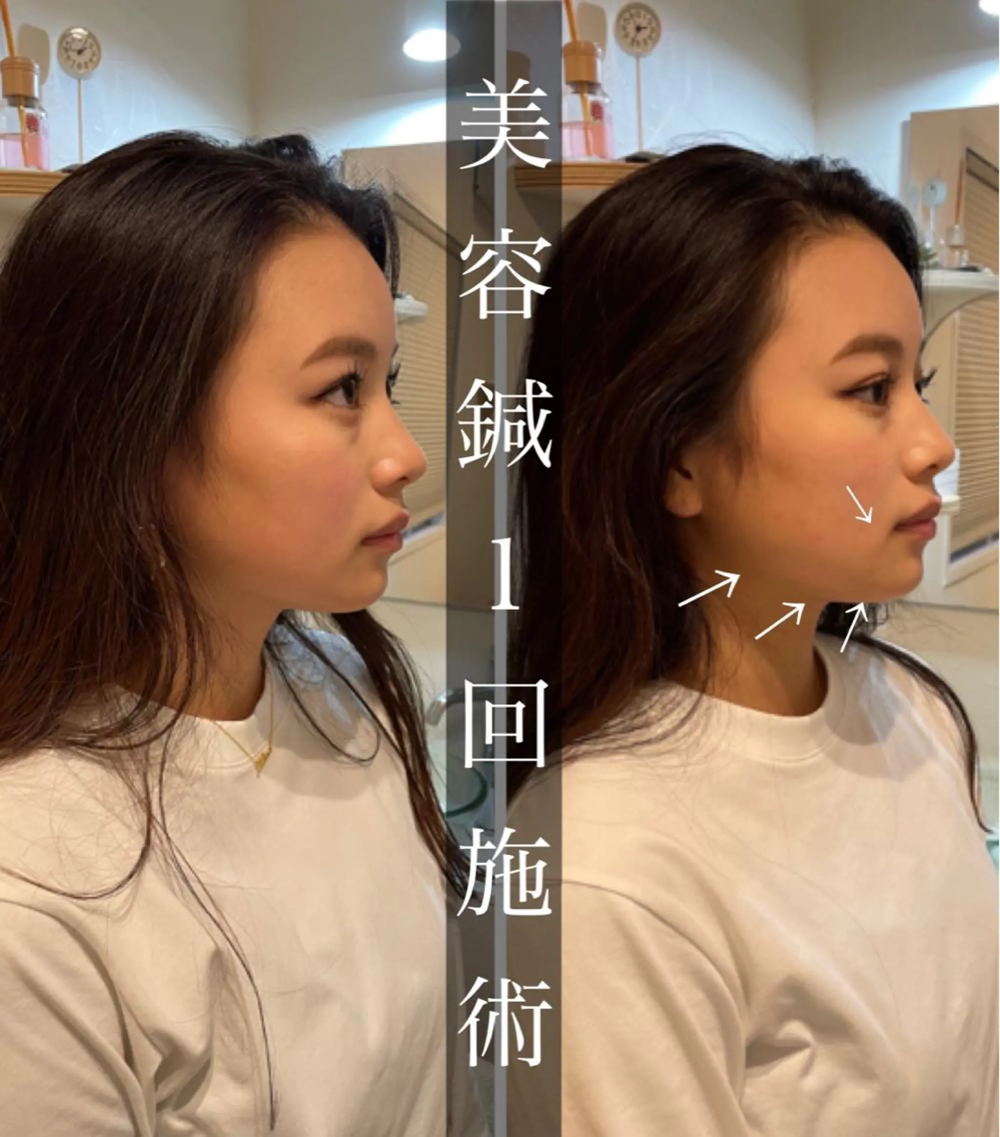 鍼灸整骨院Refine所属・鍼灸 Refineのその他イメージ