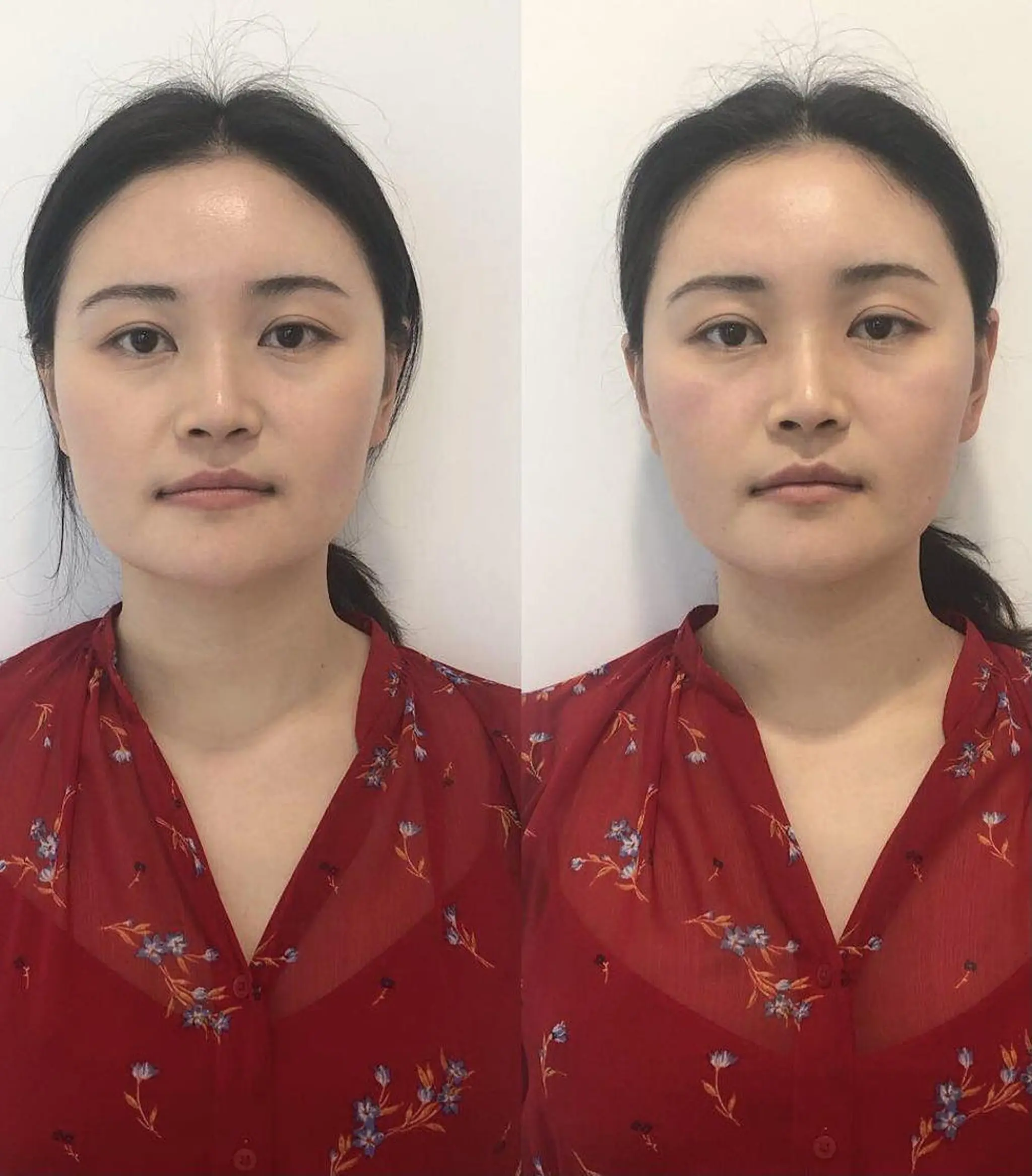 美容鍼・小顔/ 骨盤矯正/目黒/レンのエステ・リラクイメージ