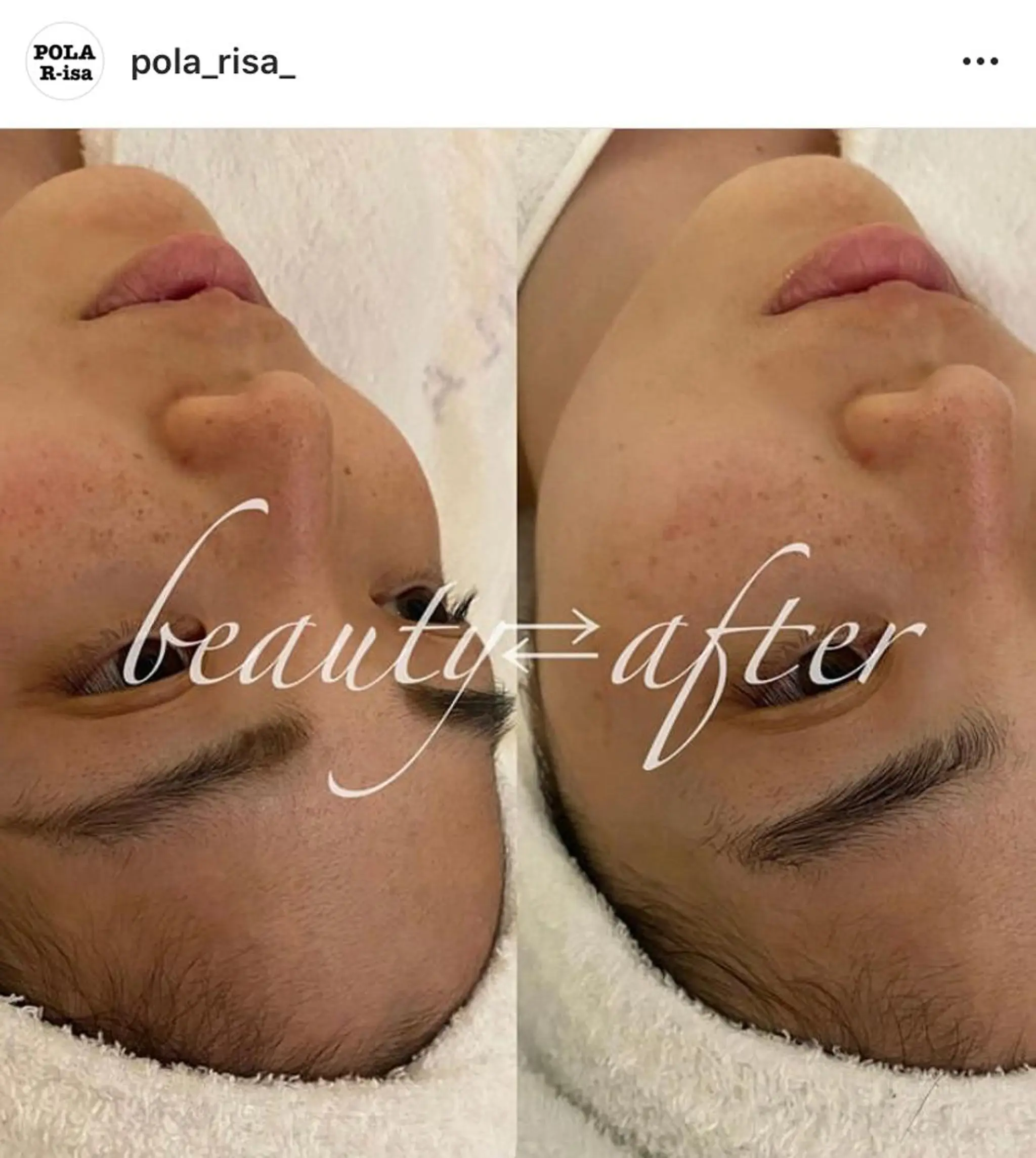 毛穴/ピーリング ララピール/POLAのエステ・リラクイメージ