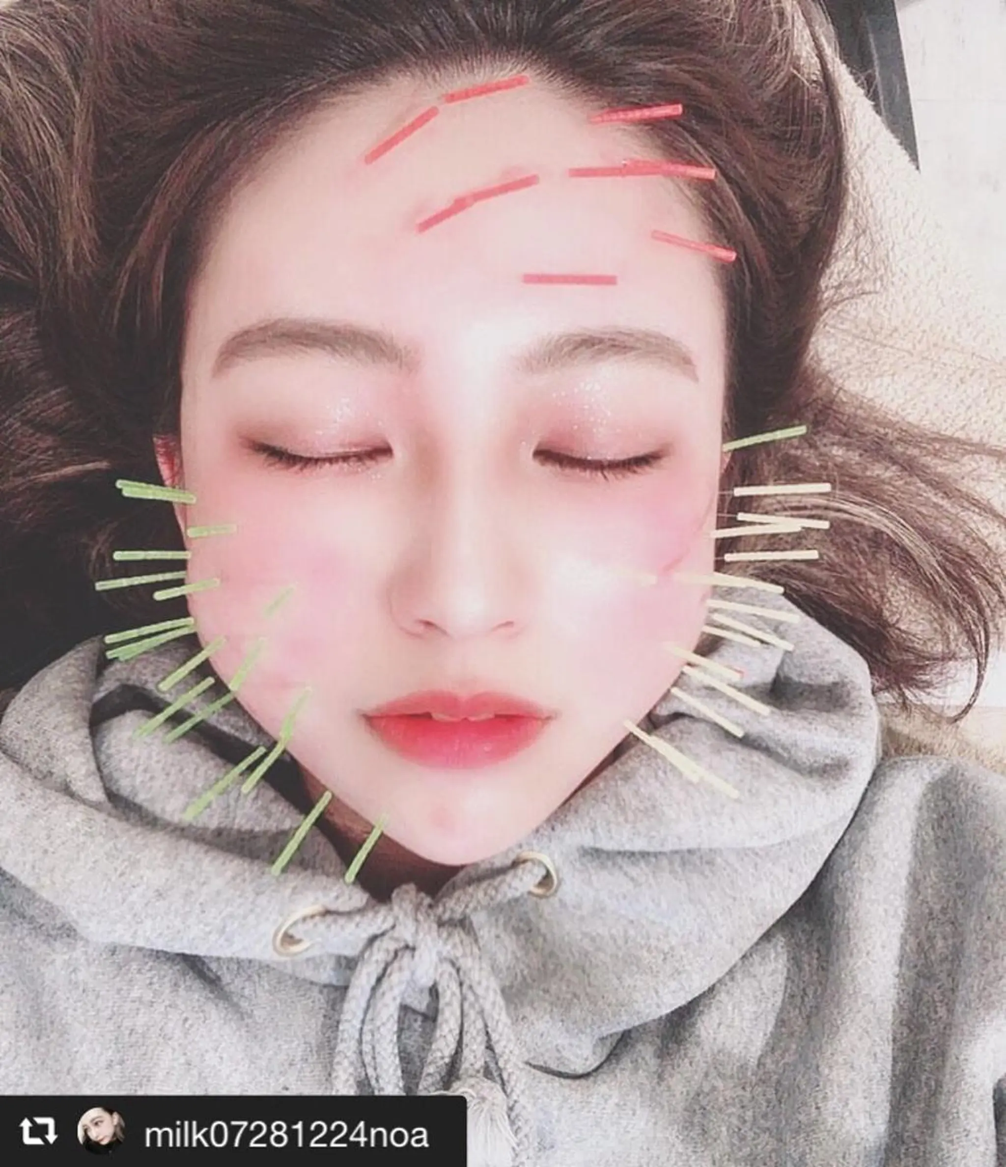 鍼灸整骨院Refine所属・鍼灸 Refineのその他イメージ