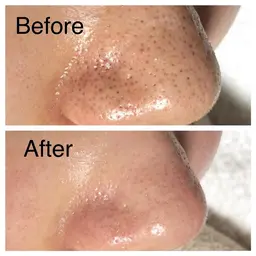 【学割U24】毛穴洗浄で毛穴レス！イチゴ鼻もキレイにツヤ肌へ♪\4000