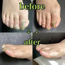 【フット】巻き爪/肥厚爪 1本 クリア/マット仕上げ