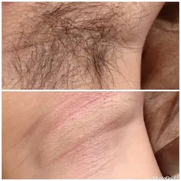 minimo限定価格🧡脇ダブル脱毛