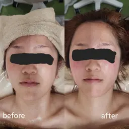 小顔マッサージ+石膏パック モニター価格