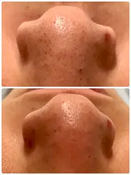 【ツルんっ‼︎と卵肌】徹底毛穴洗浄🎵ざらつき・黒ずみ毛穴・いちご鼻・化粧のノリが悪い...などにお悩みの方