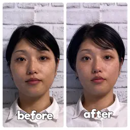 【眼精疲労・頭痛スッキリ】美容鍼×ヘッドスパ ¥14,000→¥5,980