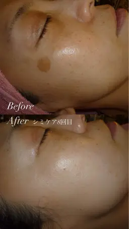 【限定10名】夏前にシミ悩み撃退！シミケア