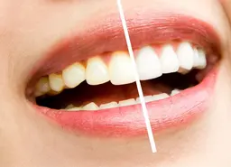 セルフホワイトニング10分×3回照射 白い歯で笑顔に自信を✨