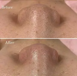 ツルツル実感!!プロの毛穴洗浄ケア◎80分