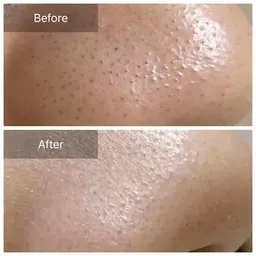 白ニキビ、毛穴に詰まっている汚れ、黒ずみ、ザラザラを徹底的に無くしたい方必見🧡毛穴洗浄ケア