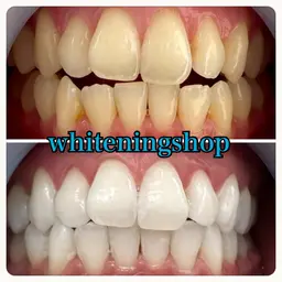 【★お得!当日クーポン★】★セルフホワイトニング★45分照射!初回お試し限定!