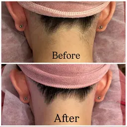 【２位🥈背中・うなじ脱毛✨¥11000→¥8250】（シェービング/角質ケア/保湿付）ご新規様限定🪽 回数：1回