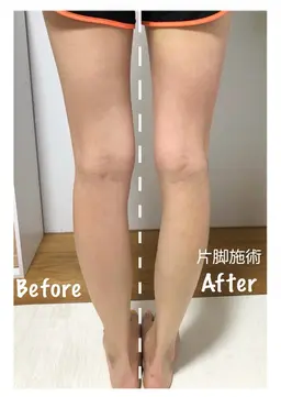 【当店人気No1】下半身痩身🦶【セルライト・むくみ・たるみ・肉割れ】施術直後のむくみ改善・脚の軽さに感動の声多数✨