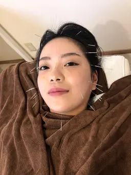 皆やってる😆NO2 美容鍼✨+ヘッドマッサージ👍