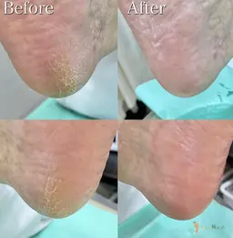 【踵の角質ケア】口コミにご協力頂ける方限定⭐︎ガサガサ踵も🦶💦しっとりスベスベの仕上がりに💕人気メニューです🤗