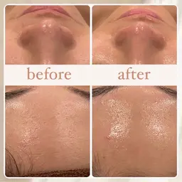 【人気No.1】✨ダウンタイム無し✨REVIハーブピーリングで陶器肌🌿ニキビ、毛穴、美肌、シミ/目指せノーファンデ