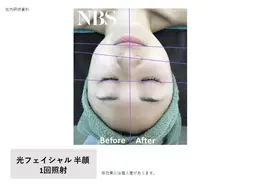 《口コミ限定》【光フェイシャル＋パック付】💆‍♀️ 小顔•美白•透明感を手に入れたい方✨気になるお肌悩みに！