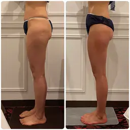 — Body Menu🦵🏻✨— 《スタイル維持》足の脂肪やセルライト・浮腫が気になる方におすすめ！ハイパーナイフEX
