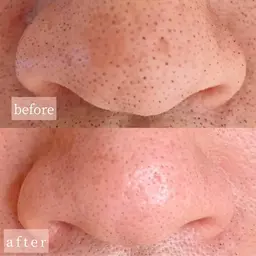 WAXでスッキリ小鼻の毛穴ケア❤️✨黒ずみザラつきスッキリ✨やみつき✨