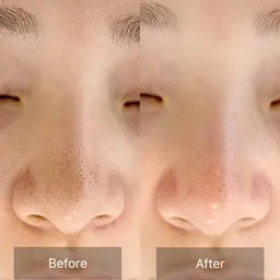 毛穴エクストラクション90分フルコース✨