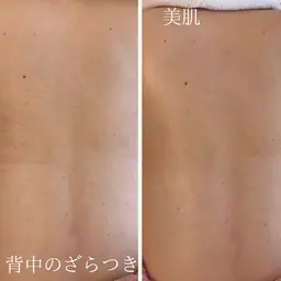 ＼夏に向けて背中美人に！背中集中ケア／ざらつき・ニキビに◎背中ピーリング+美白パック付き¥5,500