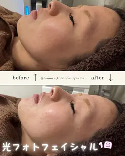 シミ・ソバカスケア💎✨光フェイシャルエステ🧖♀️