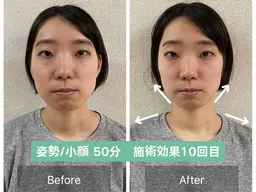 【3.40代必見！】法令線の深さ/骨格リフトアップ小顔矯正【50分17900→3400】