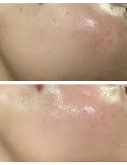 【お肌の免疫力UP✨】🎀光ケア/水光肌ピーリング/導入コース60分✨