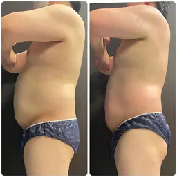 【メンズ】ハイパーナイフでお腹痩せor脚痩せ燃えコース🔥デトックスマッサージ!ぽっこりお腹、肩こり、腰痛にもアプローチ