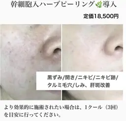 ミニモ学割【憧れの韓国肌♪】最安値/毛穴洗浄＋天然ハーブピーリング🌿剥離無、赤み・ニキビ・ごわつき