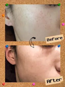 イチオシ【ご新規様限定】シミ撃退！！夏でも出来るレーザーではないシミケア‼️60ショット