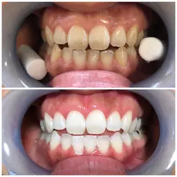 【初回ご新規様限定】ハイパワーコース〜超集中照射〜 15分×3照射