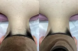 【🫧シェービング付きうなじ脱毛🫧】形を丁寧にご相談いたします✨RAYVIS自慢の2段階シェービングで仕上がり抜群✨