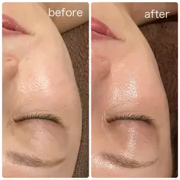 すっぴんツヤ肌✨LDM🫧&ラミネーションピール 120min