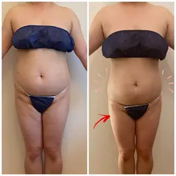 切らない脂肪吸引【整形級ダイエット】上半身痩せスッキリコース＋岩盤浴❤️ぽっこりお腹，二の腕、背中のはみ肉さよなら✨