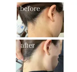 まるで元から生えてなかったかの様な"うなじ脱毛"