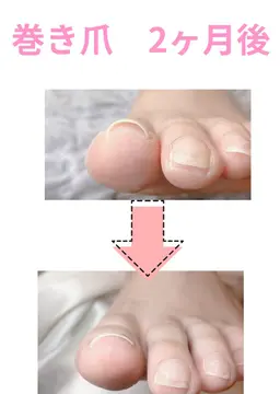 巻き爪 レジスタンスシート 親指のみ一本2000円