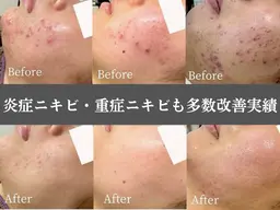 【まずは】一時的でないニキビ根本改善◎ニキビ専門サロン・お肌無料相談