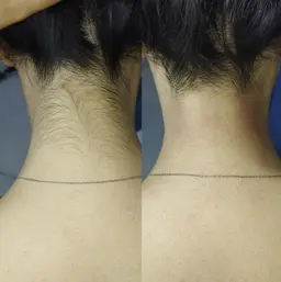 全身脱毛丸投げお試し価格！最新LEDマシーン！！！IPL脱毛は、時代遅れ！フェイシャルパック付き！