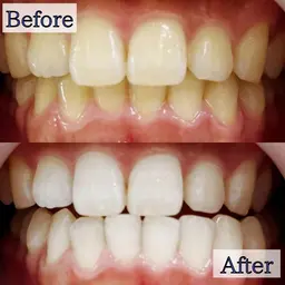 【人気No.1👑】5分照射×2回💎通常の約2倍の照射パワーで即効果実感✨最新高速セルフホワイトニングが大人気🦷