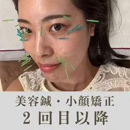 美容鍼・小顔整体 2回目以降